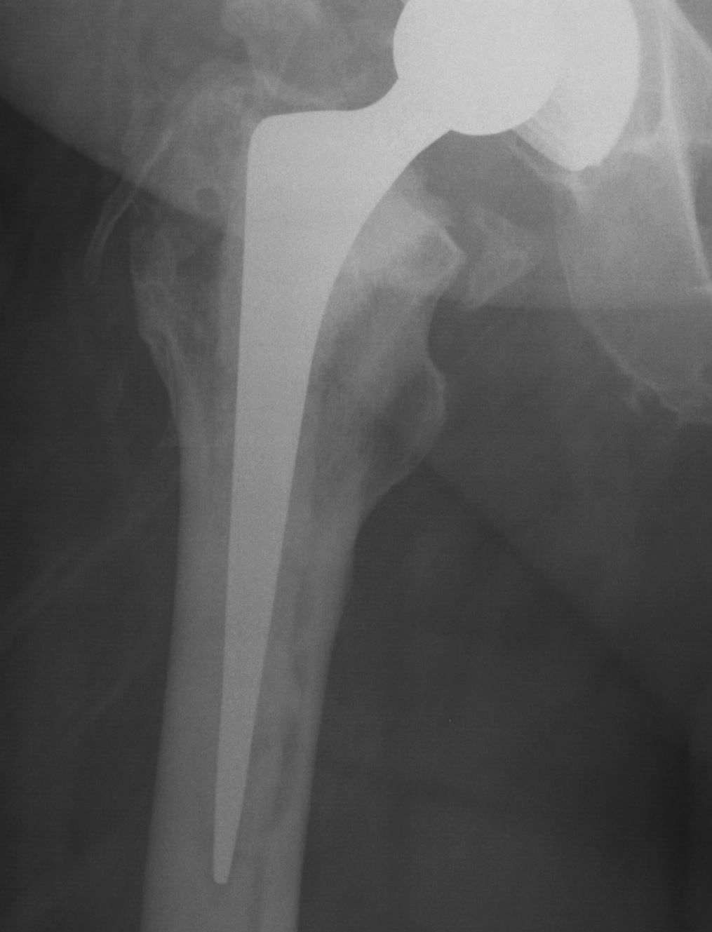 Revision Femur Type 1 Standard Cemented Stem Post op